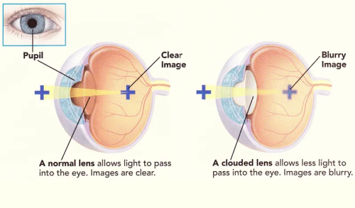 Cataracts-1.png