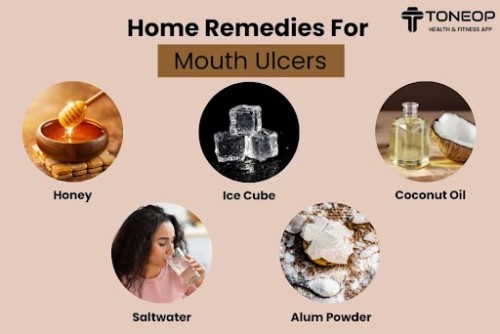 Home-Remedies-For-Mouth-Ulcers.jpg