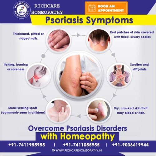 Psoriasis-Homeopathy-Treatments-in-Bangalore--Rich-Care.jpg