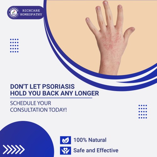 Psoriasis-Treatments---01.jpg