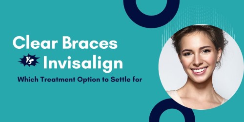 Clear-Braces-vs.-Invisalign_-Which-Treatment-Option-to-Settle-for.jpg