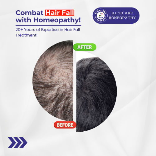 20-Years-of-Expertise-in-Hair-Fall-Treatment.png