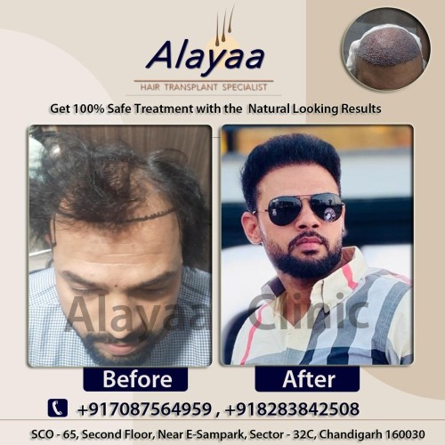 Top-Hair-Transplant-Specialist-in-Chandigarh-Quality-Hair-Restoration-Services.jpg