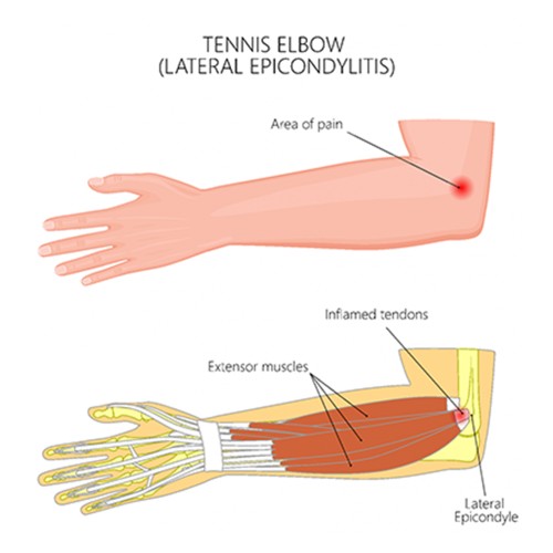 tennis-elbow-4-1.jpg