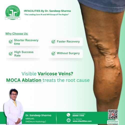 MOCA-Ablation-for-Varicose-Veins--Treat-the-Root-Cause-at-IRFacilities.jpg