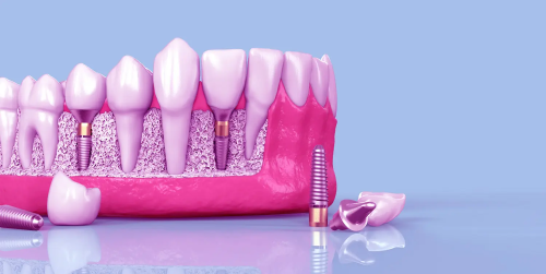 dental-implant.png